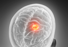 Dawson Hastalığı Nedir?