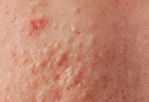 Püstüler Döküntü Hastalığı Nedir?